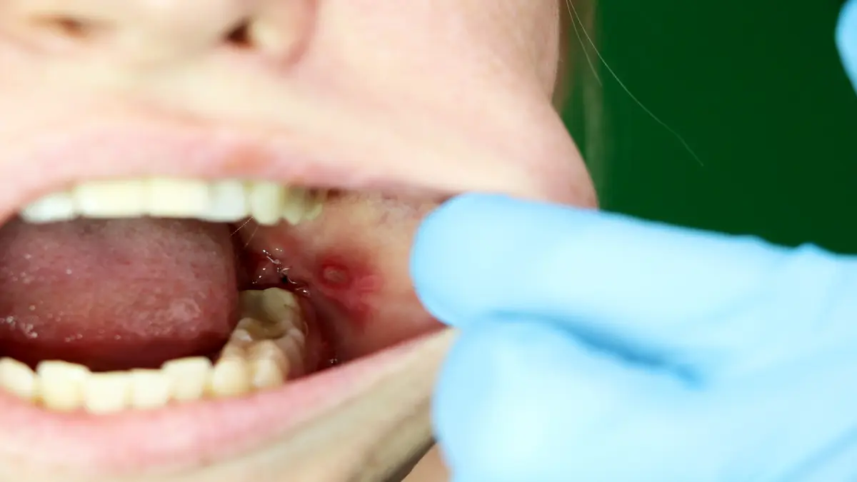 Two dentists reviewing a patient's tooth infection during a clinical consultation, with dental instruments and overhead light visible.