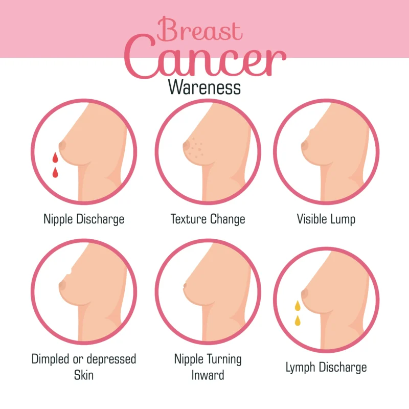 5 Stages of Breast Cancer