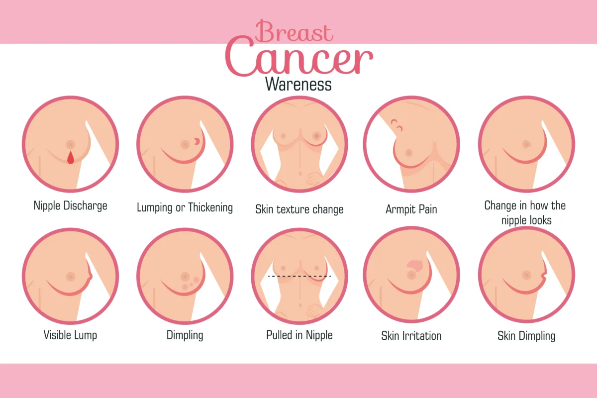 5 Stages of Breast Cancer