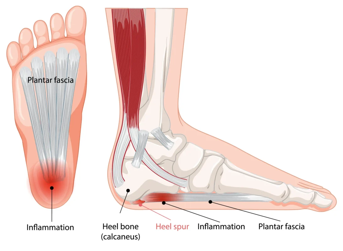 Heel Spurs Therapy