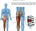 Treatment for Sciatica Physical Therapy