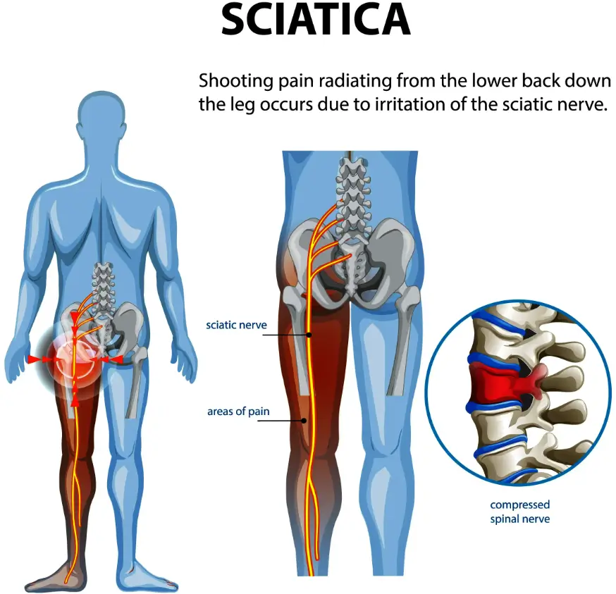Treatment for Sciatica Physical Therapy