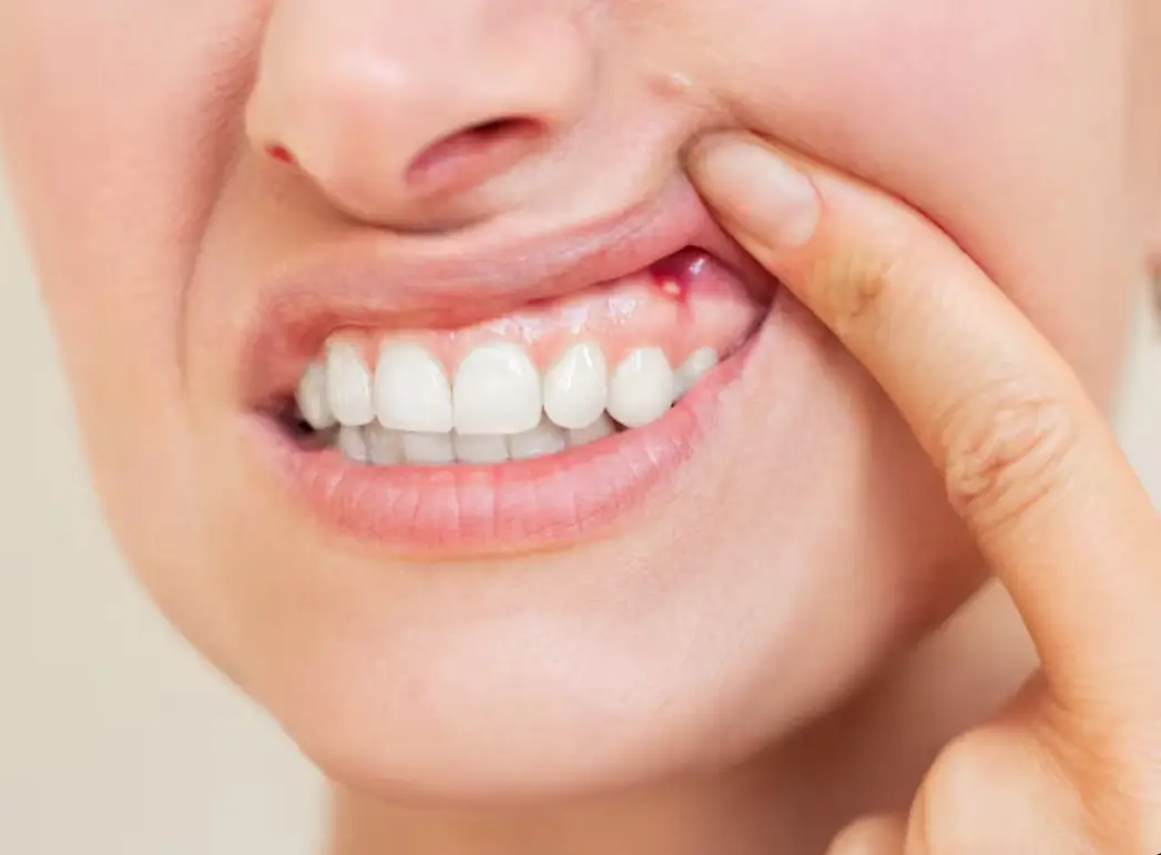 White Spots on Gums